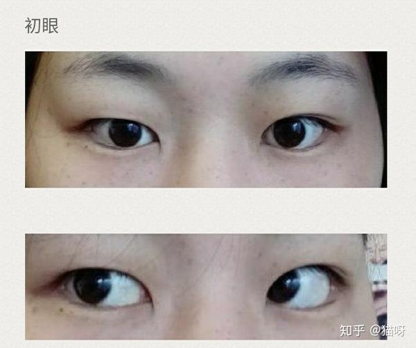没做之前眼睛一个内双一个外双睡觉睡好了就可以翻出来睡不好就大小眼