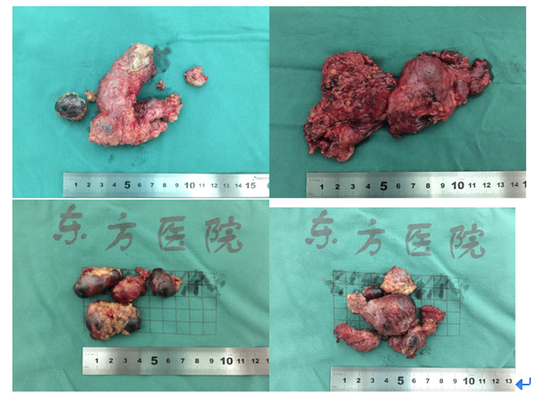 频繁淋巴结转移—甲状腺癌术后难题