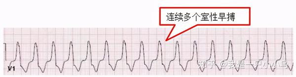 心电图特征:在心电图中,连续3个或3个以上的室性早搏,频率在150-200次