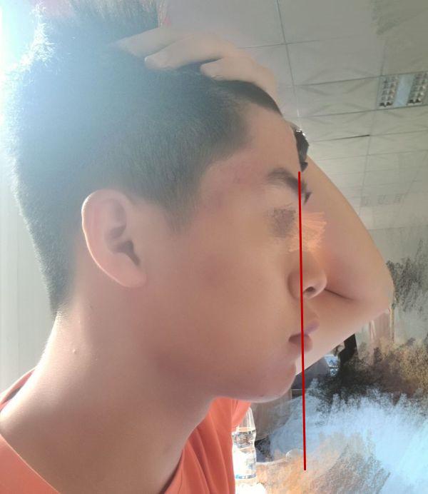 请问这是凸嘴吗?有没有矫正的方法?