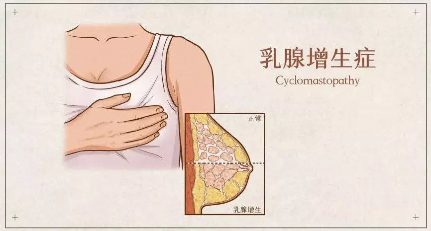 一,年纪轻轻查出乳腺问题,会变成乳腺癌吗?