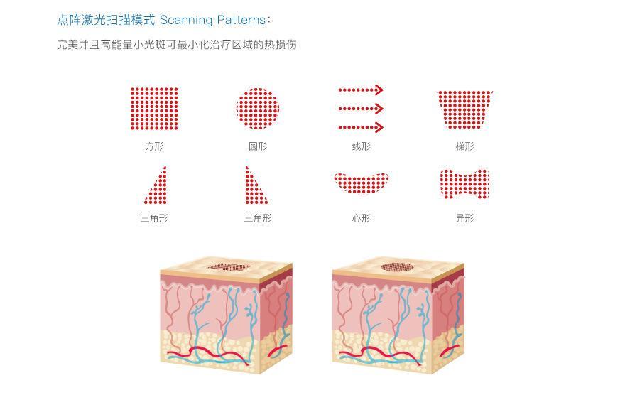 超脉冲co2点阵激光可以治疗哪些皮肤问题