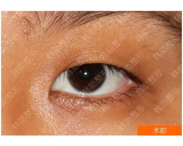 具有代表性的单眼皮如何设计手术