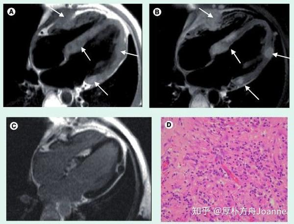 心脏也会得恶性肿瘤?现在知道还不算迟!