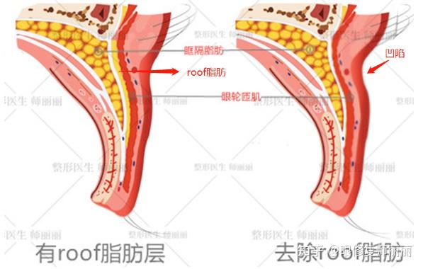 关于roof脂肪的一点想法 我的观点还是 能不去尽量不要去roof脂肪