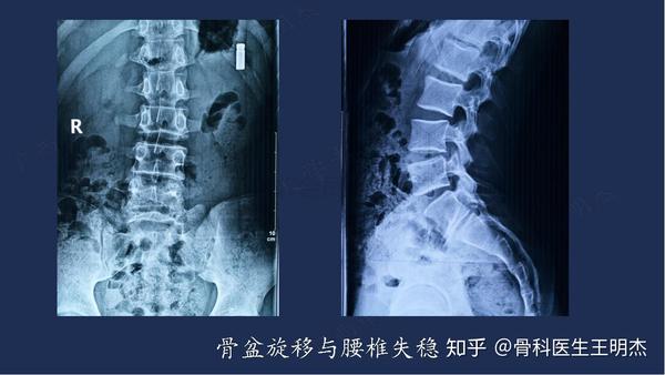 骨盆旋移综合征柔性整复术