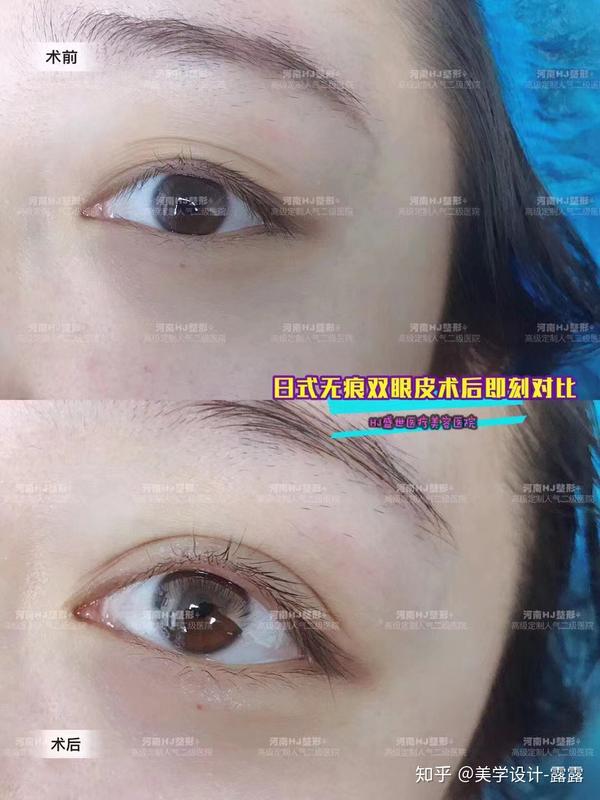 最受欢迎的双眼皮形状,第二种是公认的最好看,你觉得呢