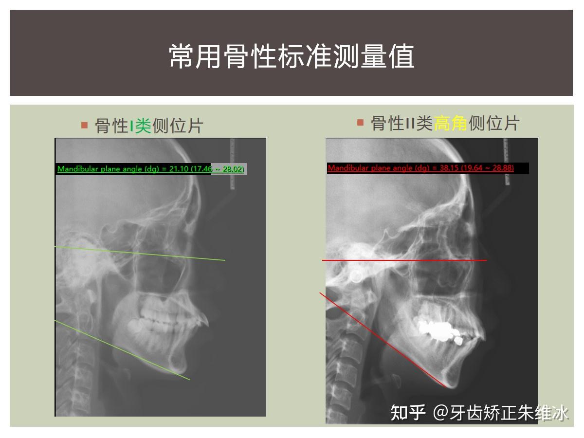 南京牙齿矫正如何辨别自己是骨性前突还是牙性前突骨性一定要做手术吗