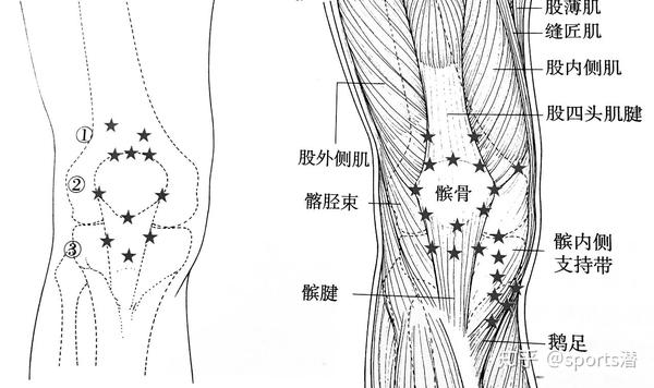 鹅足 → 鹅足炎 半膜肌止点 → 半膜肌止点炎 内侧副韧带 → 内侧