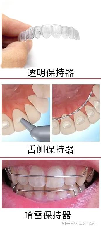 由于舌侧丝很细,固定在牙齿内侧,可以和哈雷或隐形保持器一起佩戴.