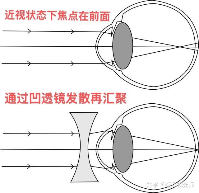 单眼近视戴眼镜时比不戴眼镜时视物更清晰是怎么回事?