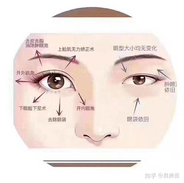 割双眼皮和做眼综合应该如何选