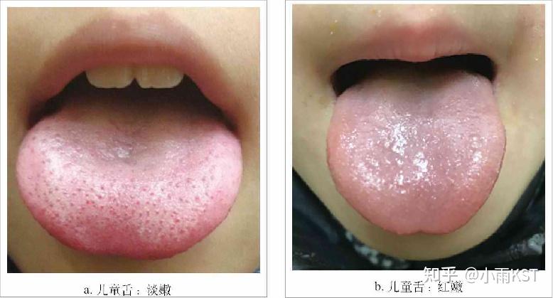正常舌象舌色淡红鲜明,舌质滋润,舌体大小适中,柔软灵活自如,老嫩胖瘦