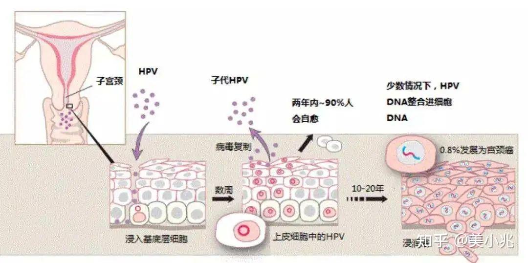 感染hpv病毒就会恶变成宫颈癌吗造成宫颈癌的真正原因究竟是什么