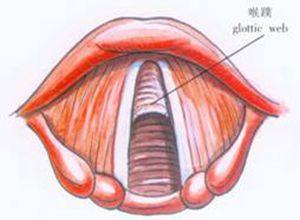 可能是先天性喉蹼,先天性喉下垂,先天性声带麻痹和先天性喉喘鸣等问题
