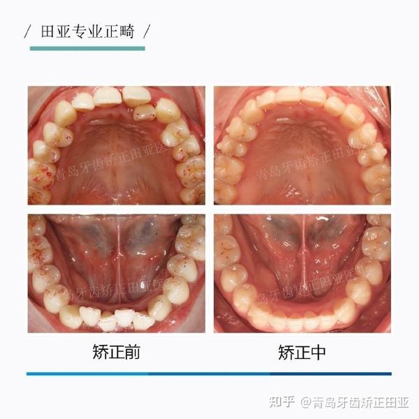 看看这例不拔牙解除中度拥挤的正畸病例
