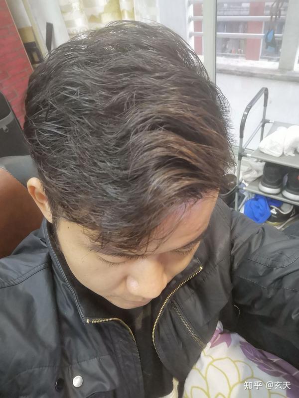 非那雄胺与米诺地尔使用一年半的效果