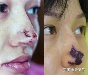 过量注射玻尿酸隆鼻至鼻尖坏死