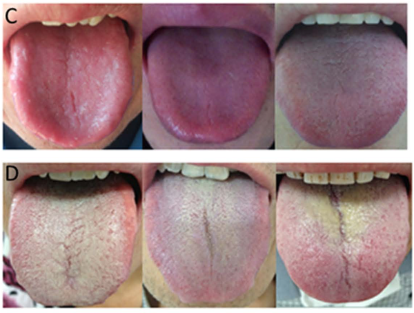 图:c为健康受试者舌苔图;d为慢性糜烂性胃炎患者舌苔图 来源:doi: 10