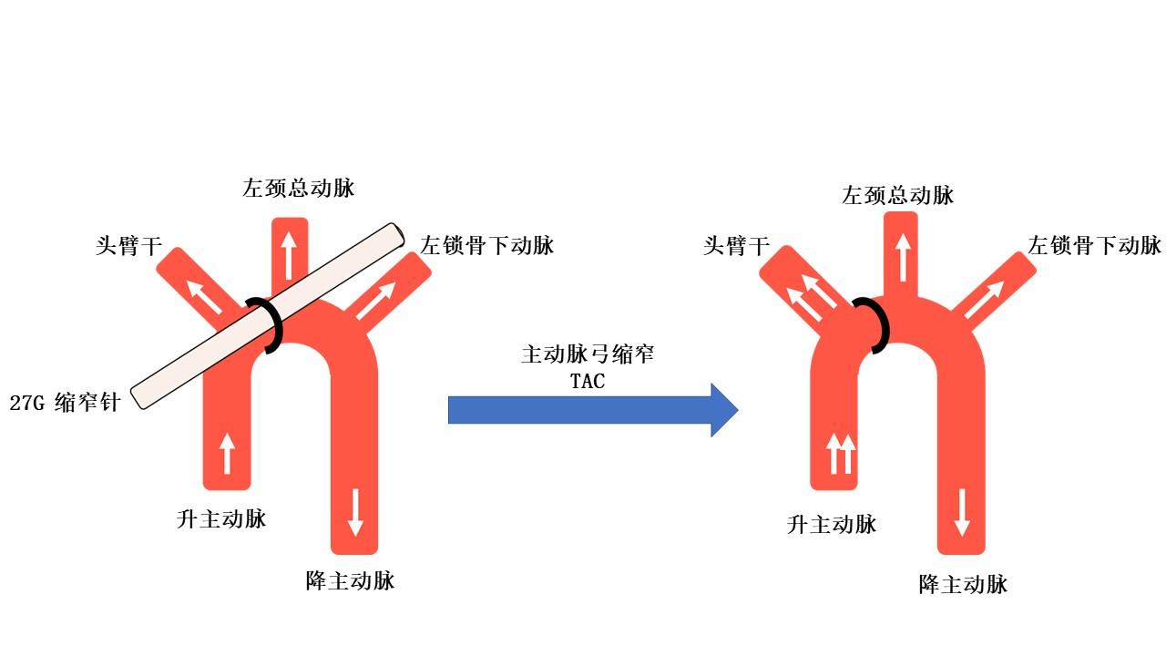 导师我会做主动脉弓缩窄模型