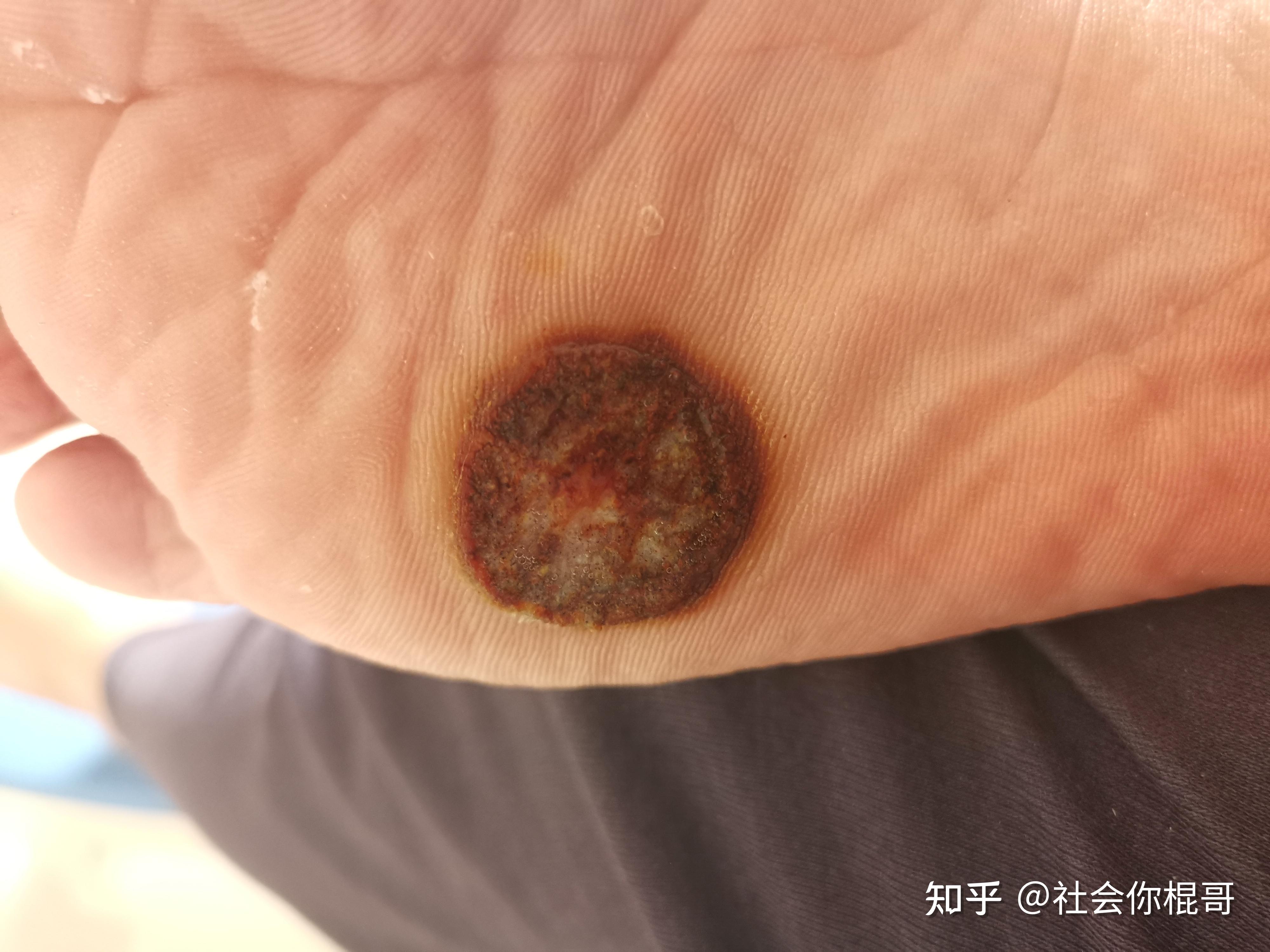 切身体会碘酊治疗重度跖疣