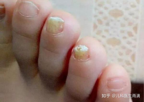 2,宝宝大了,就要考虑宝宝是不是营养不良或身体出现问题,造成指甲