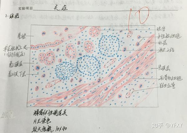 红蓝铅笔图绘图,b.镜下照片. 包含:1.肉芽组织,2.慢性肺淤血,3.