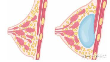  单纯假体隆胸△>   因此医师会采用乳房上提术   和维纳斯美胸max