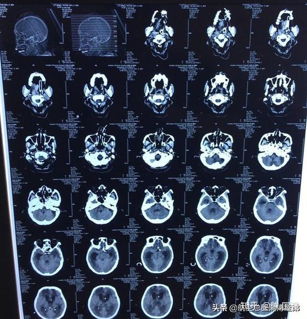 6月3日ct 显示双侧脑室大量积脓