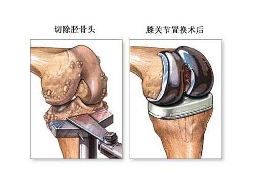 健康科普 且行且珍膝膝关节炎科普 知乎