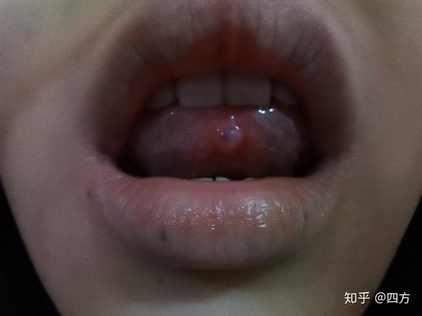 上海第九人民医院舌粘液囊肿治疗经历