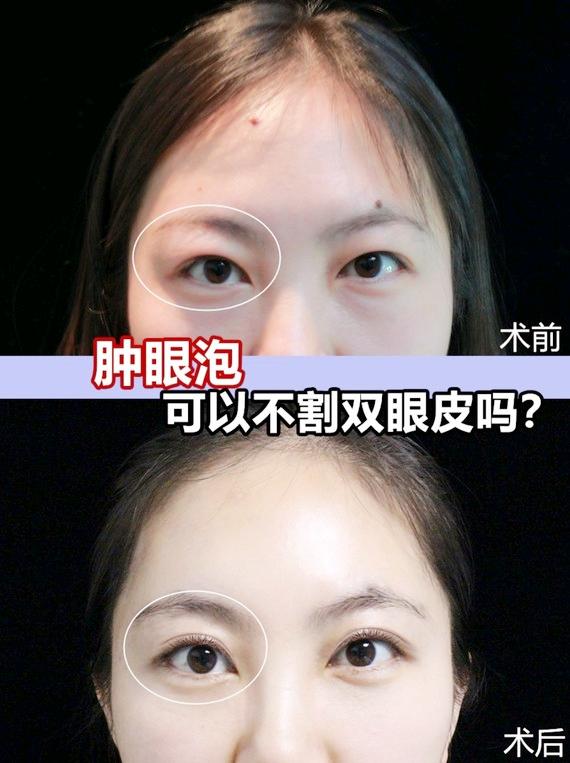 肿眼泡不割双眼皮吗?如何去除肿眼泡?