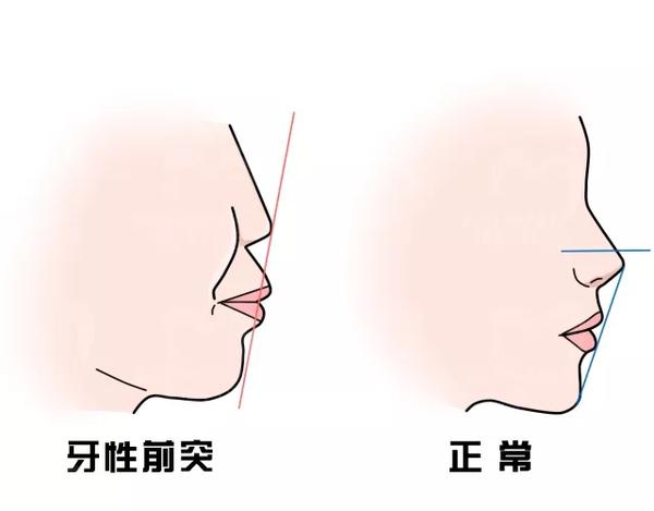 矫正牙齿对我们的脸型影响有多大龅牙兜齿哪种情况做矫正效果最明显在