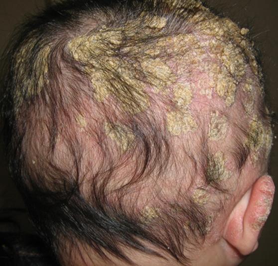 湿疹表现为皮肤红,皲裂,结痂为表现,渗出型时才有黄色液体或者结成痂.