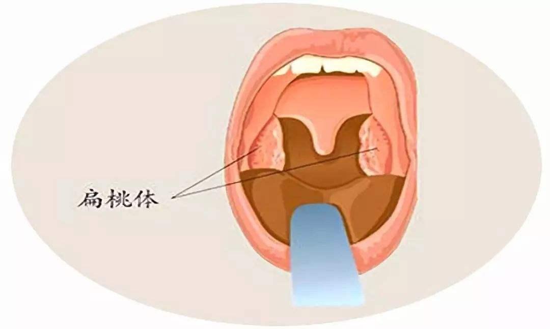 北京首大眼耳鼻喉医院侯丽珍:扁桃体癌和扁桃体炎有没