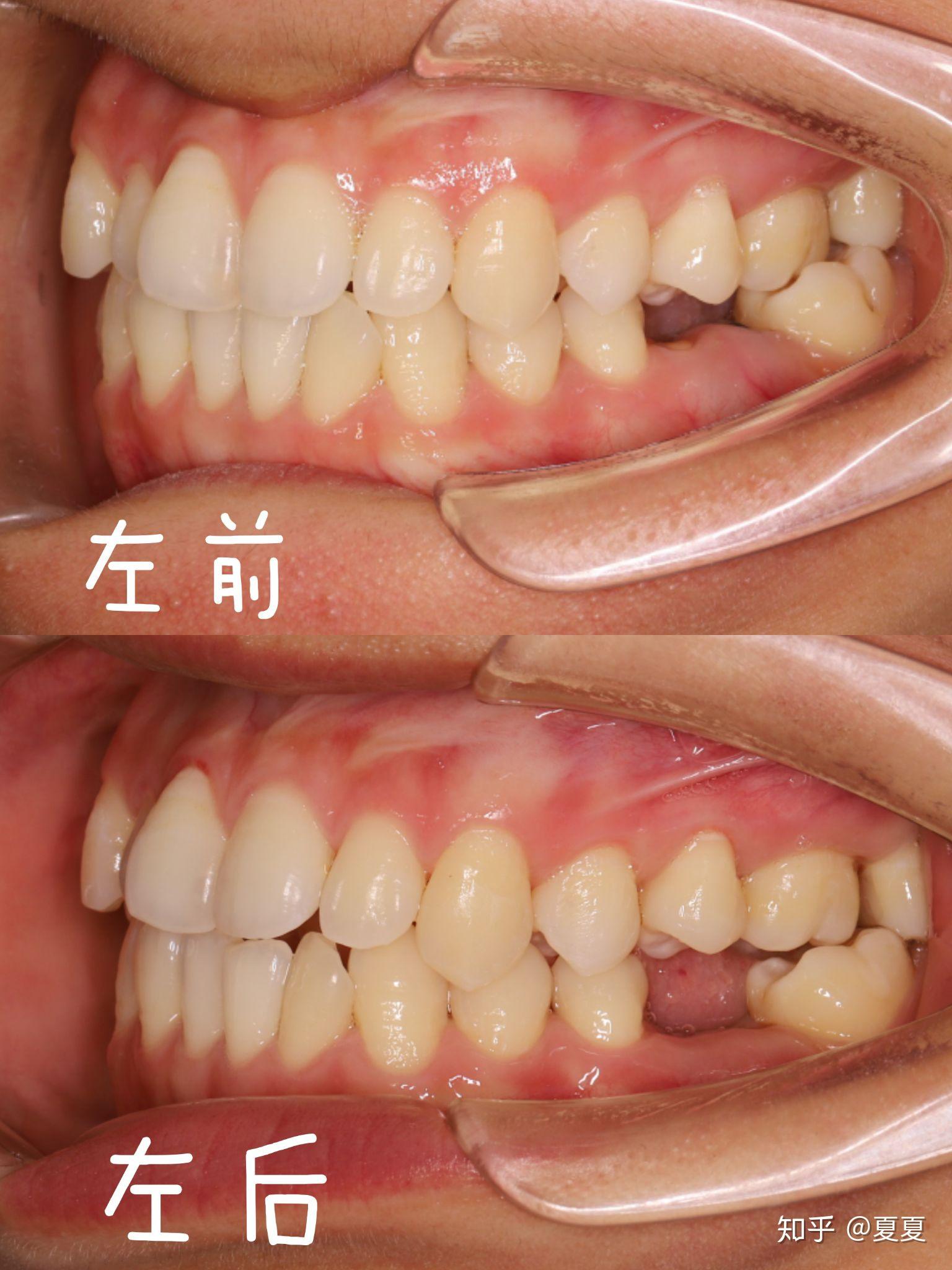 对颌牙伸长怎么办呐