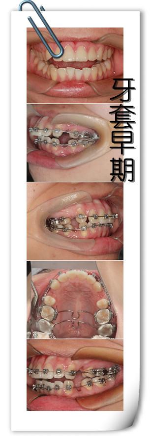 以至于我疯狂的刷牙,疯狂地跑医院,疯狂地刷牙套论坛,疯狂地照镜子.