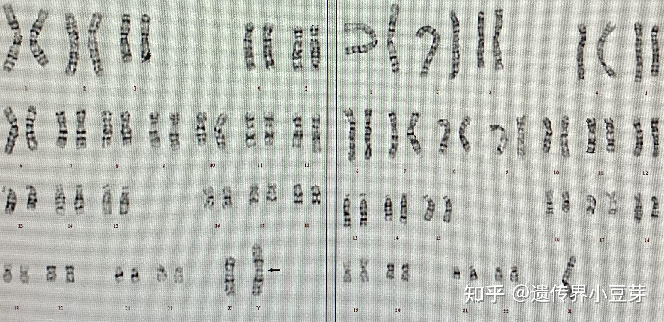 除了主要的45,x以外,与tuner综合征有关的核型还有46 x,i(xq)等多种