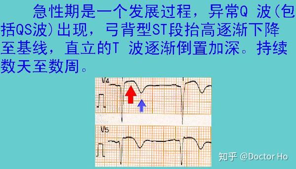 主要改变是出现损伤型st段抬高,未出现异常q波,t波直立高耸.