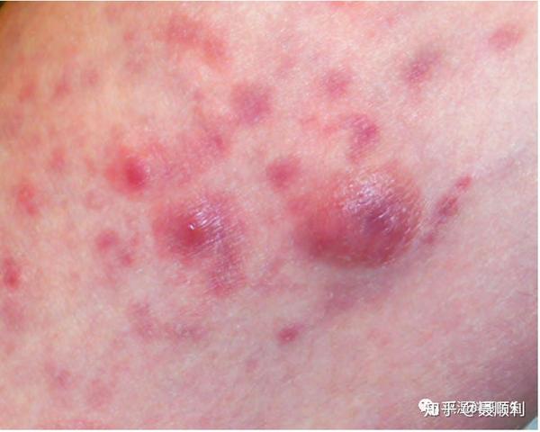 同时,淋巴瘤丘疹是原发性皮肤 t 细胞淋巴瘤,必须病理检查.