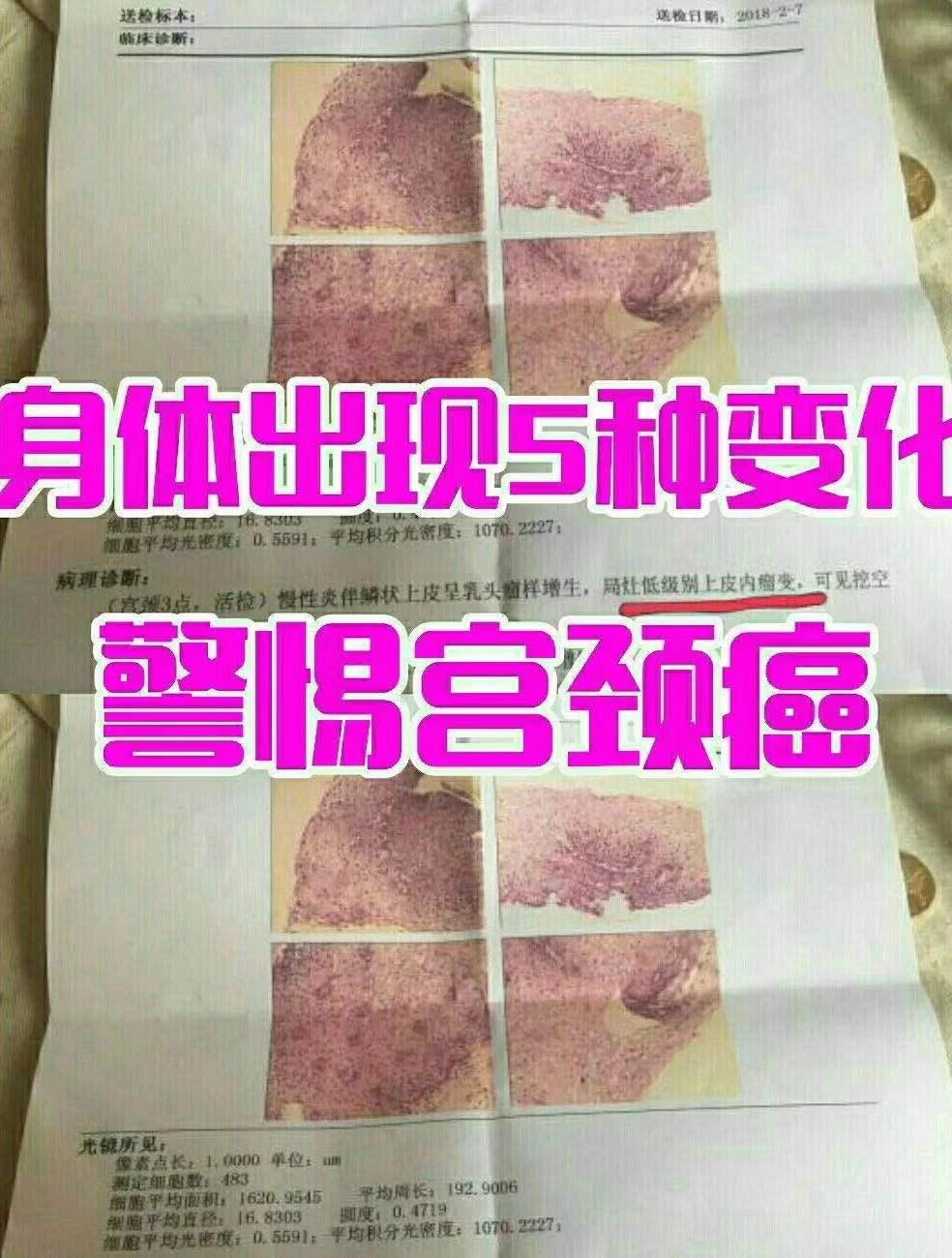 早期的症状不怎么明显,至容易跟月经不调,其他简单的妇科