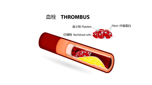 血小板你怎么成了动脉硬化和动脉血栓的帮凶