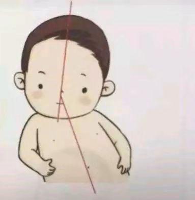 宝宝出现了斜颈怎么办?