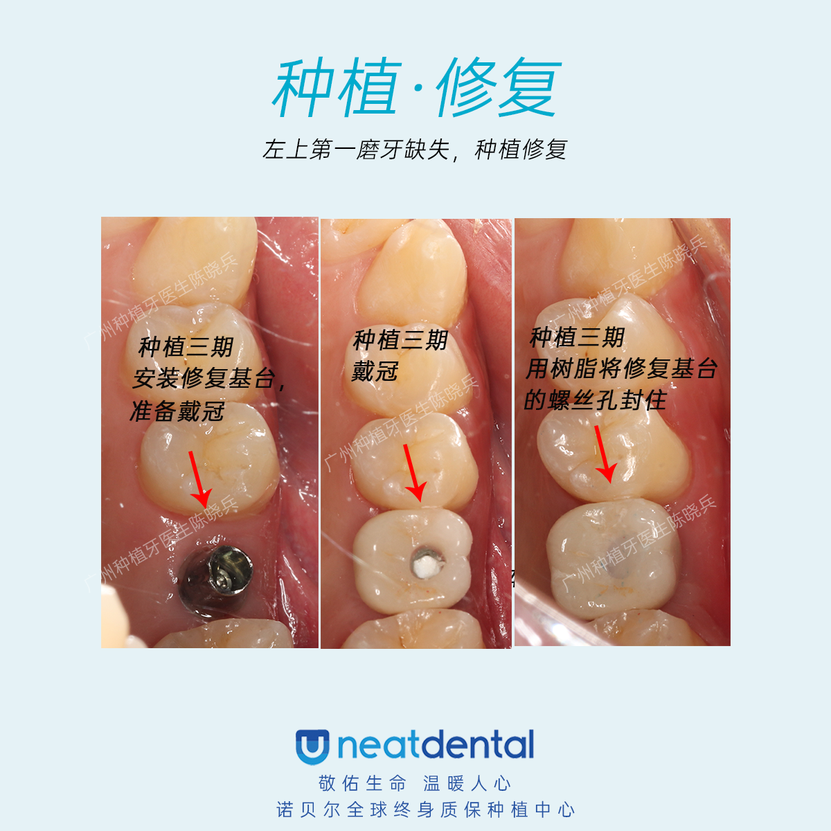 最后一点,关于医生的种植牙案例数量和效果,这也是患者了解种植牙效果