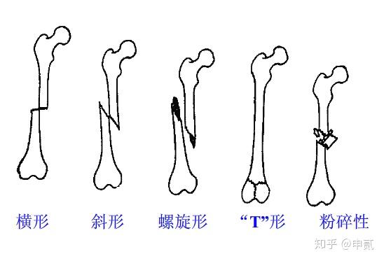 (2)完全骨折