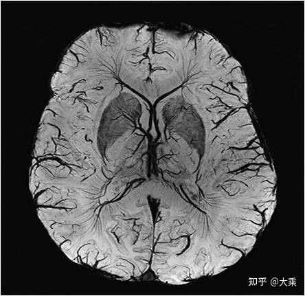 ct增强和mri在影像上的区别?