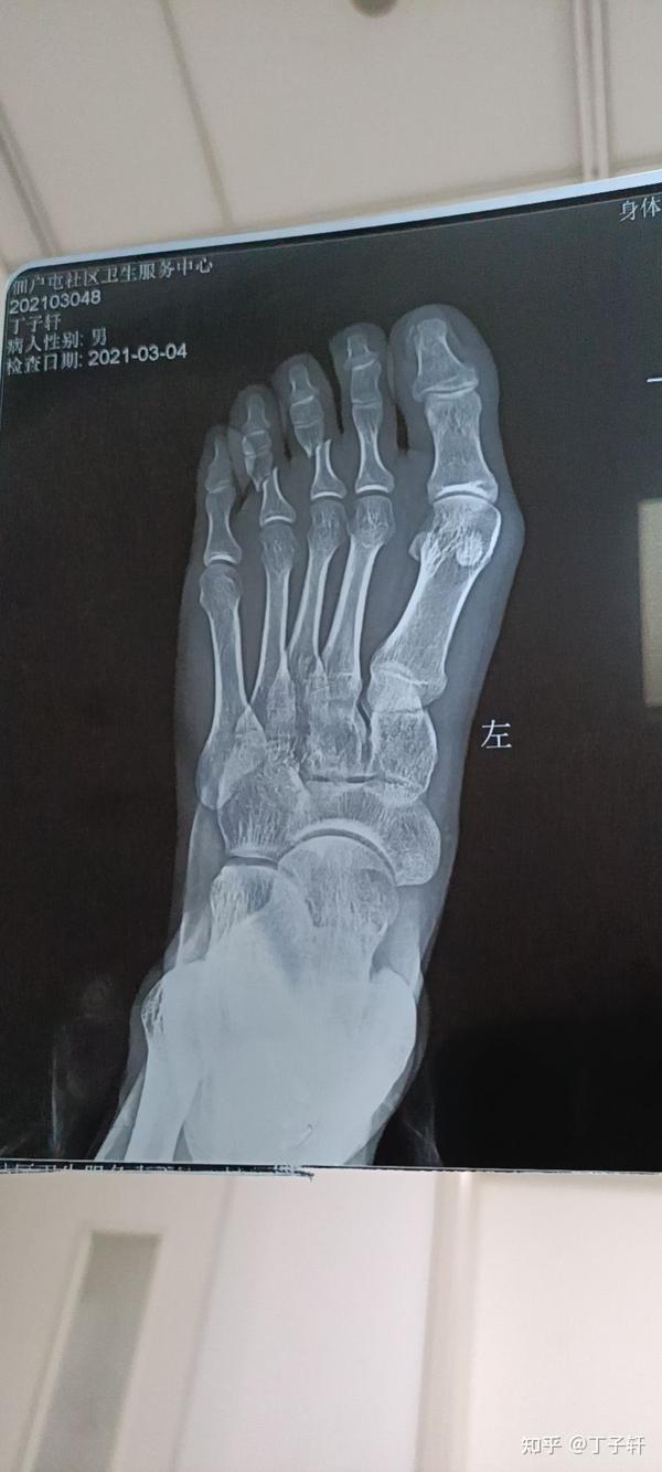 左脚第45脚趾骨折恢复记录