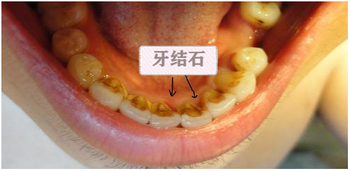 口腔头号杀手"牙结石",到底有多可怕?