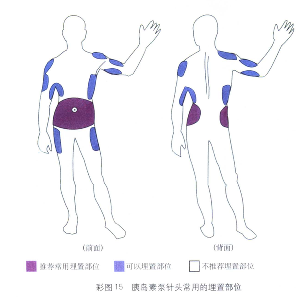 不同的胰岛素泵专用输注导管的比较