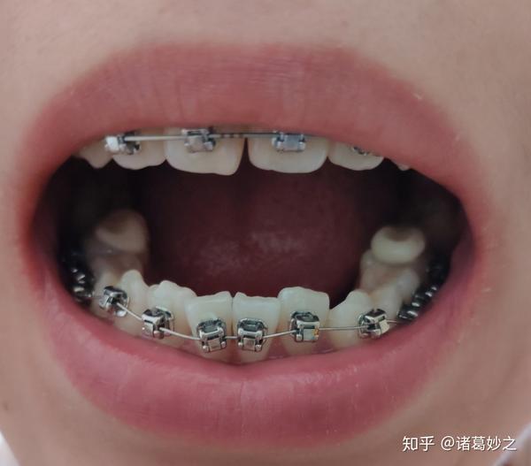 抖音这个特效不错,刚好放大嘴巴牙齿(ò  ó) 6月5,这几天左边三号呀